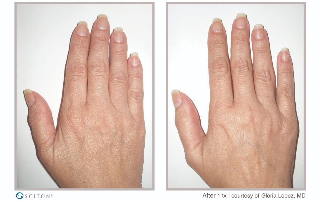 Before and After SkinTyte Treatment Case 5