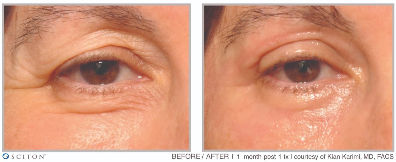 Before and After Deep Laser Resurfacing Treatment Case 3