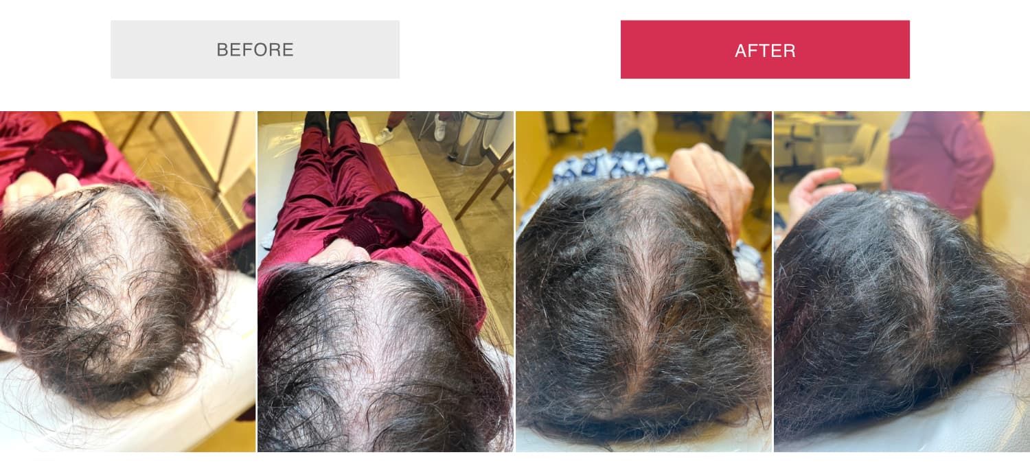 Before and After MOXI Treatment Case 3