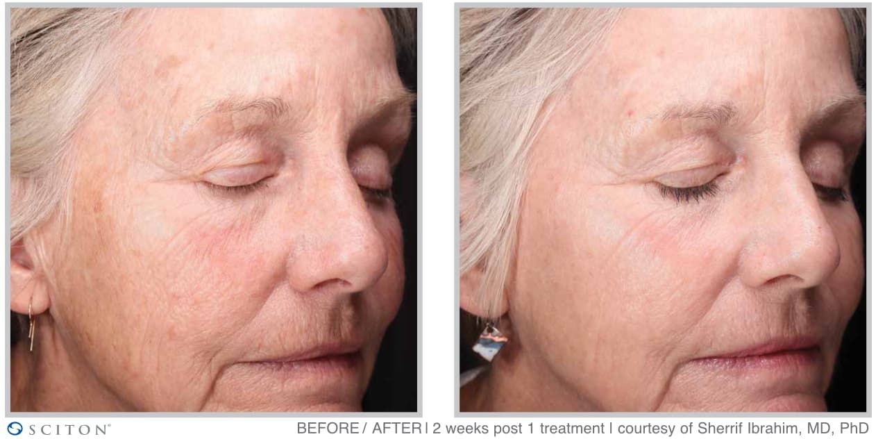 Before and After MOXI Treatment Case 3