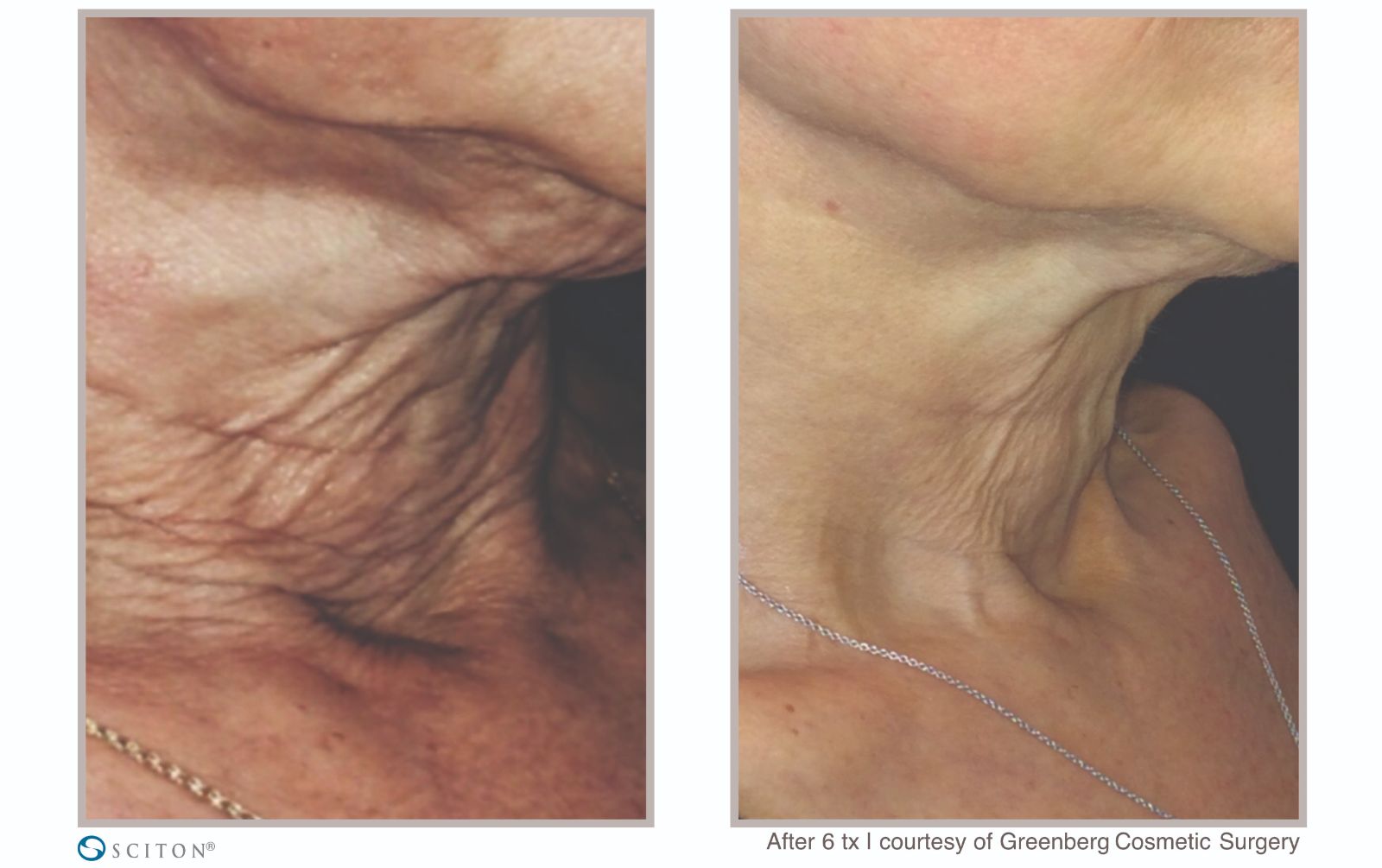 Before and After SkinTyte Treatment Case 4