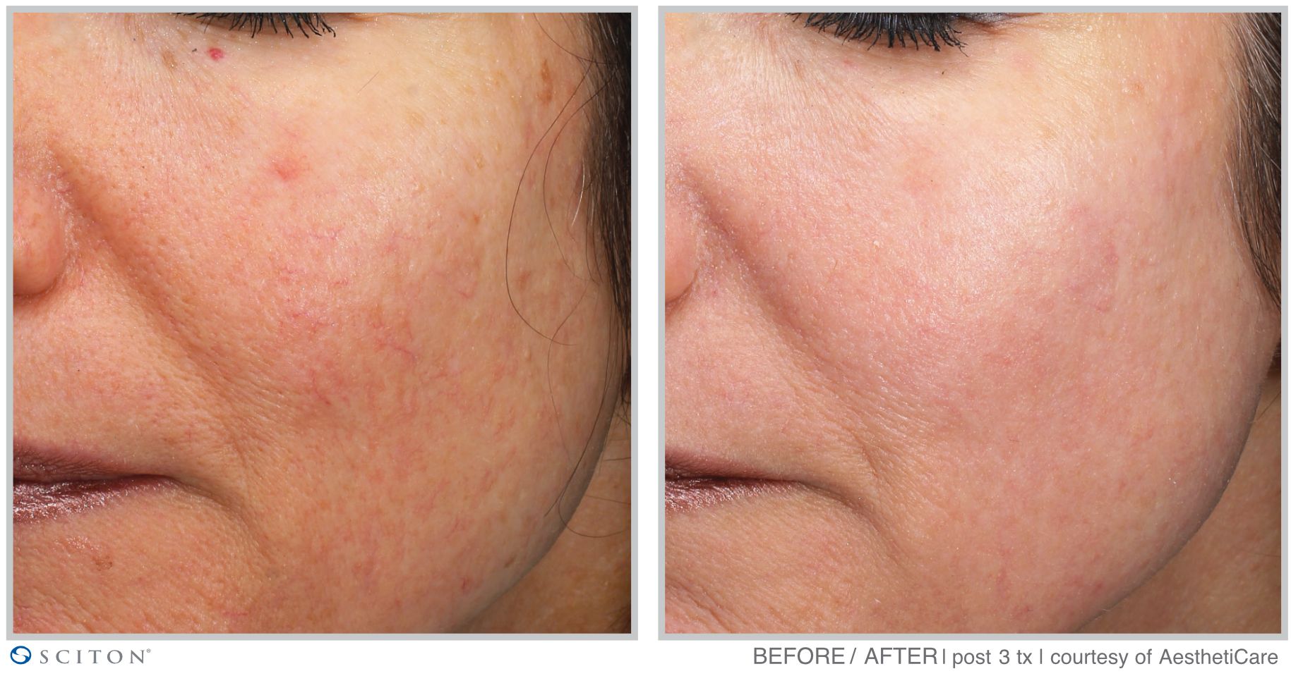 Before and After MOXI Treatment Case 3