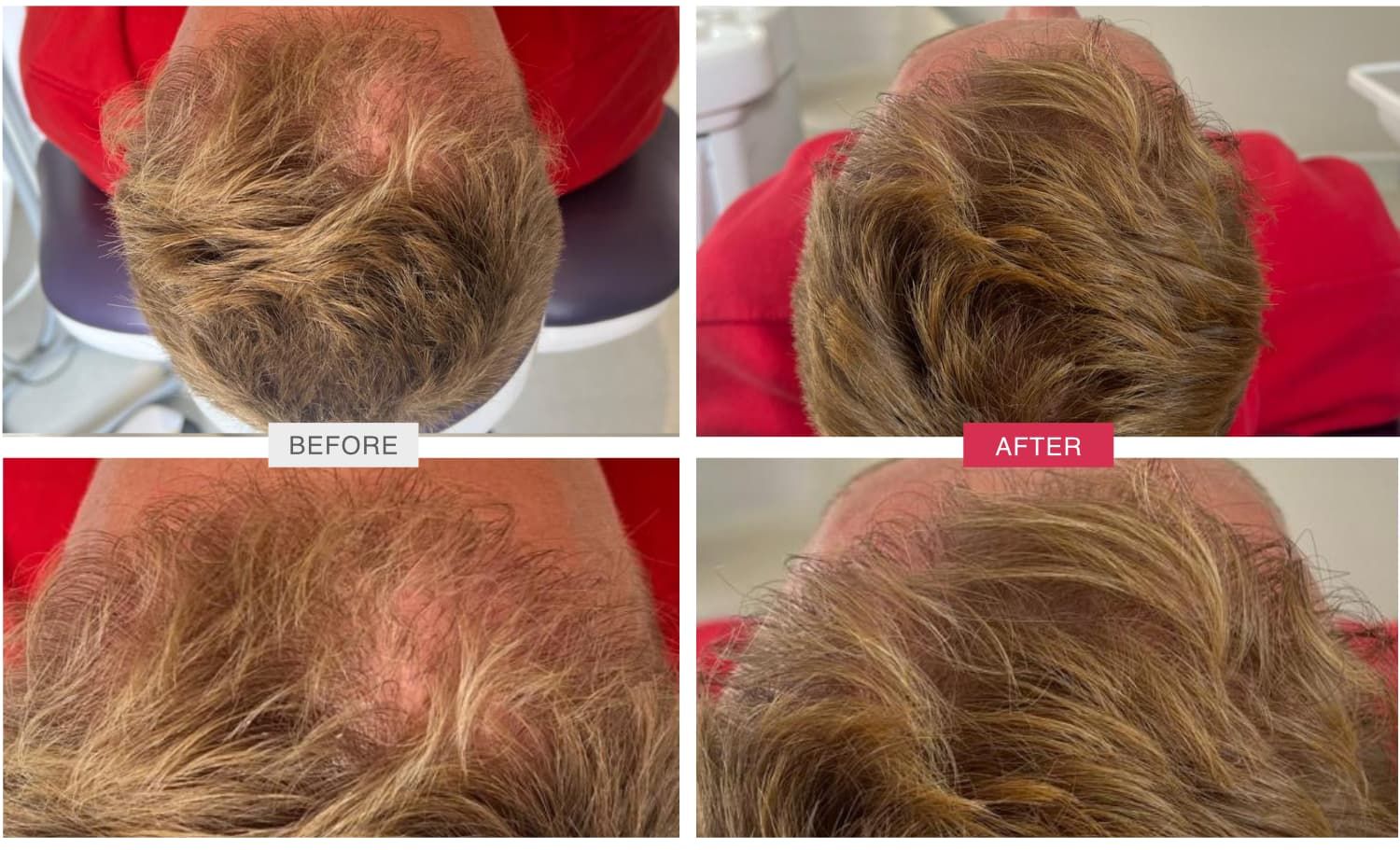 Before and After MOXI Treatment Case 1
