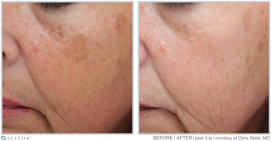 Before and After MOXI Treatment Case 2