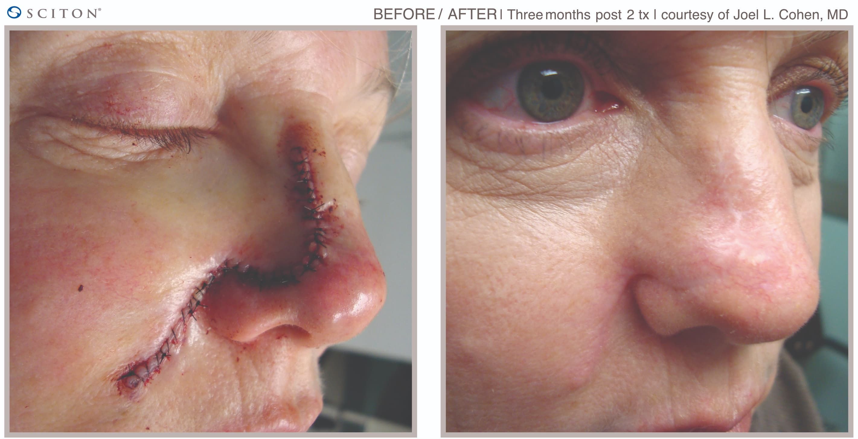 Before and After DLaser Scar Treatment Case 2