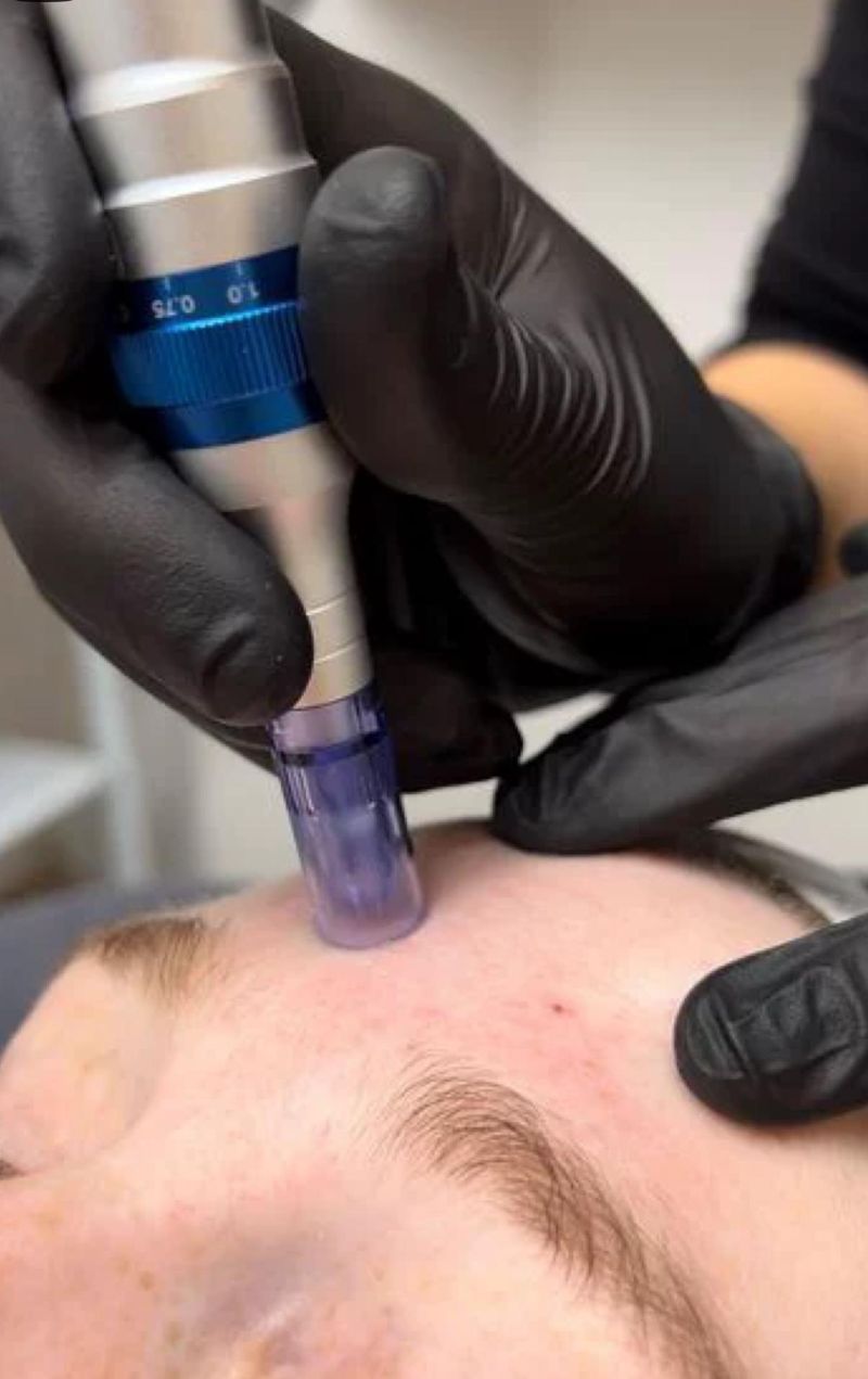 Microagujas con PDRN