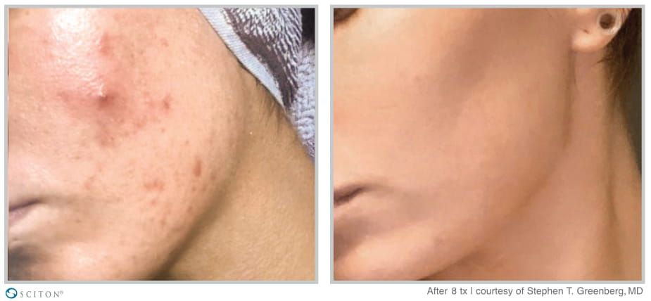 Before and After BBL Forever Clear Treatment Case 2