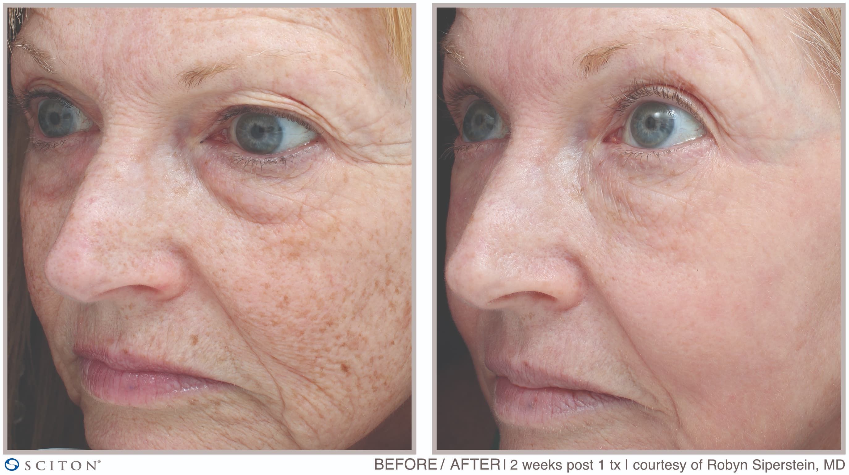 Before and After MOXI Deep Laser Resurfacing Treatment Case 1