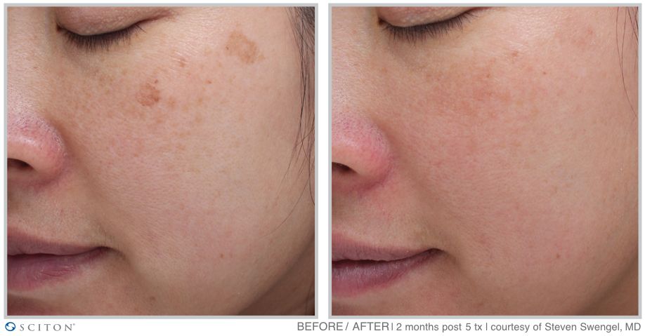Before and After MOXI Treatment Case 1