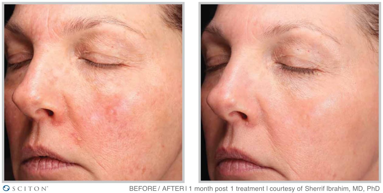 Before and After MOXI Treatment Case 2
