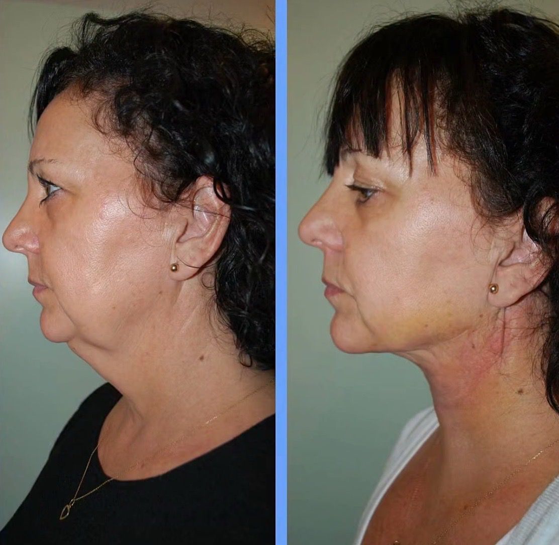 Jawline Definition Results