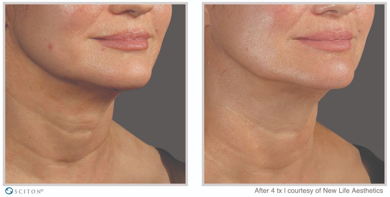 Before and After SkinTyte Treatment Case 1