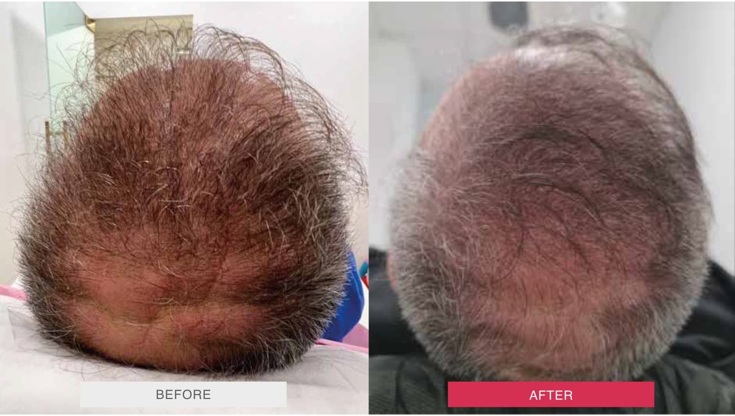 Before and After MOXI Treatment Case 2