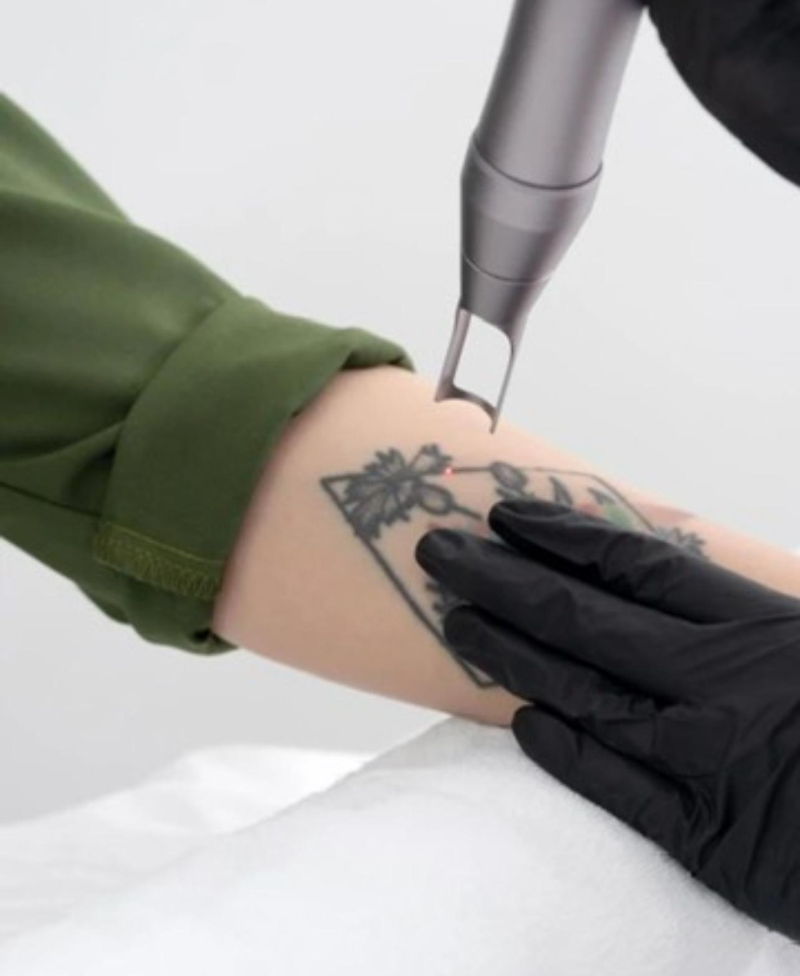 Remoción de Tatuajes