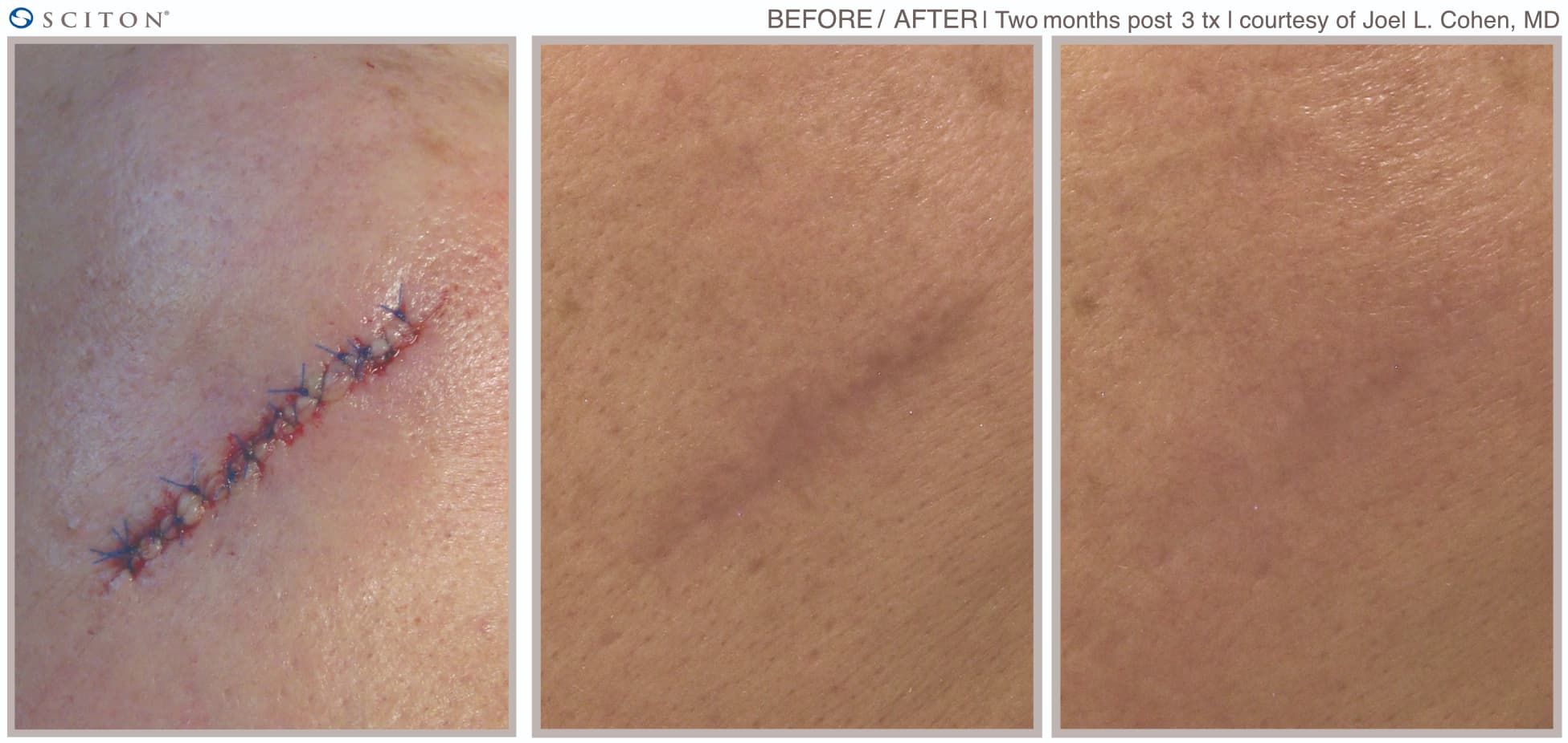 Before and After Laser Scar Treatment Case 3