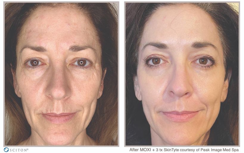 Before and After SkinTyte Treatment Case 3
