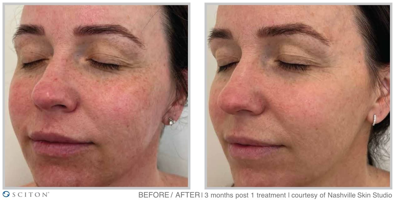 BBL HEROic Patient Results Case 3