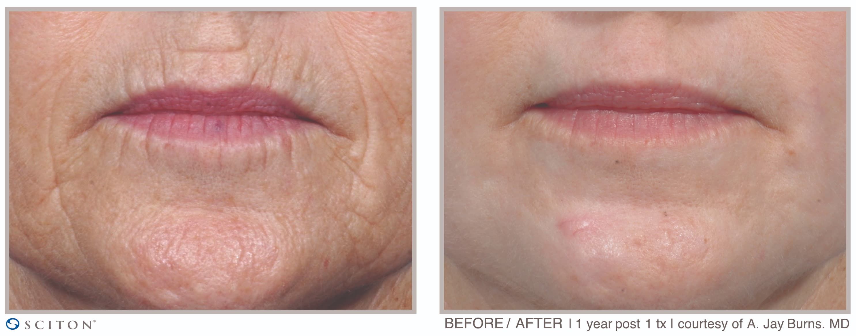Before and After Deep Laser Resurfacing Treatment Case 2