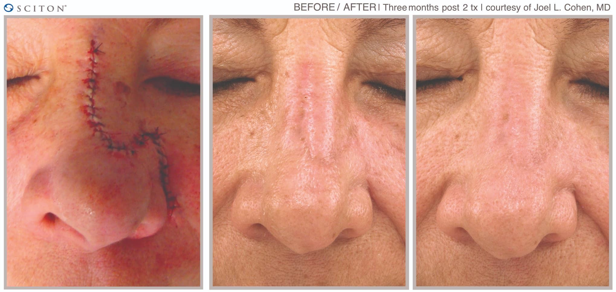 Before and After Laser Scar Treatment Case 1