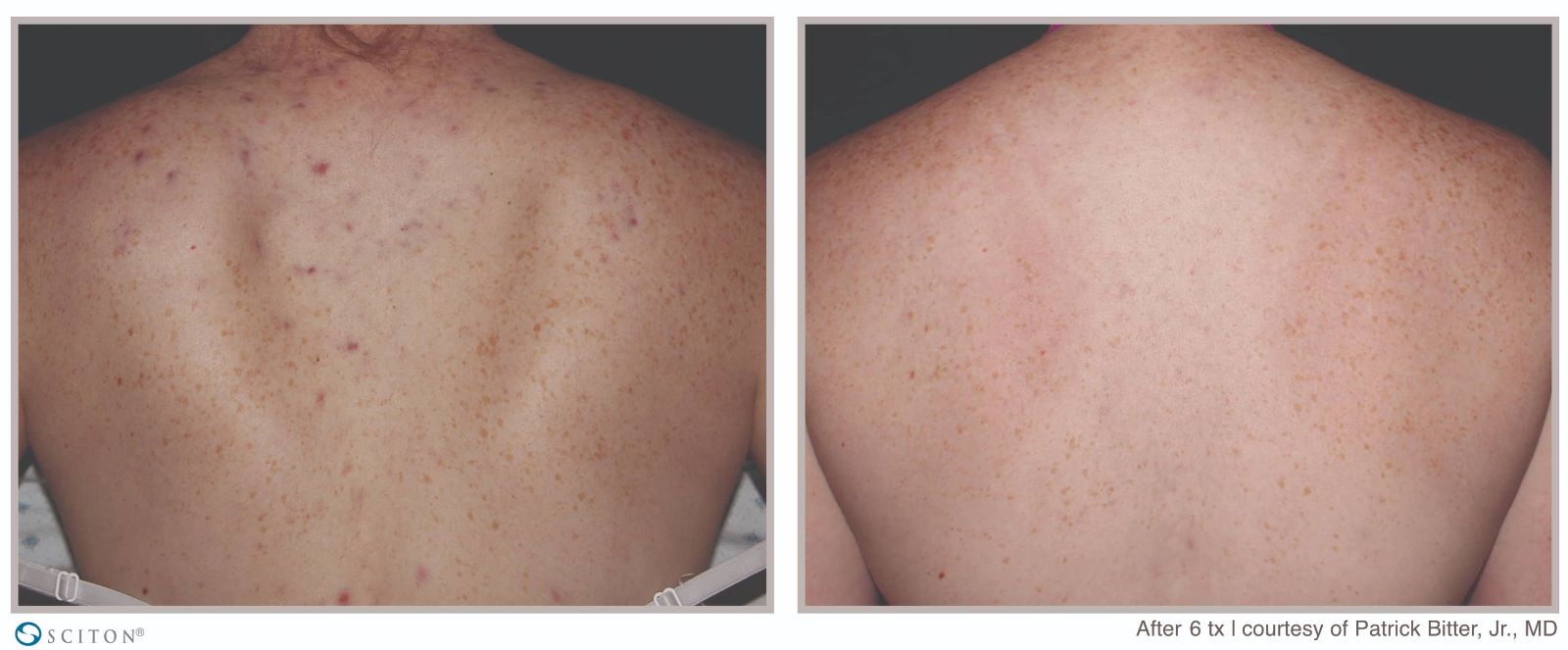 Before and After BBL Forever Clear Treatment Case 3