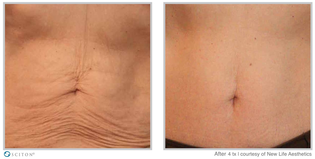 Before and After SkinTyte Treatment Case 2
