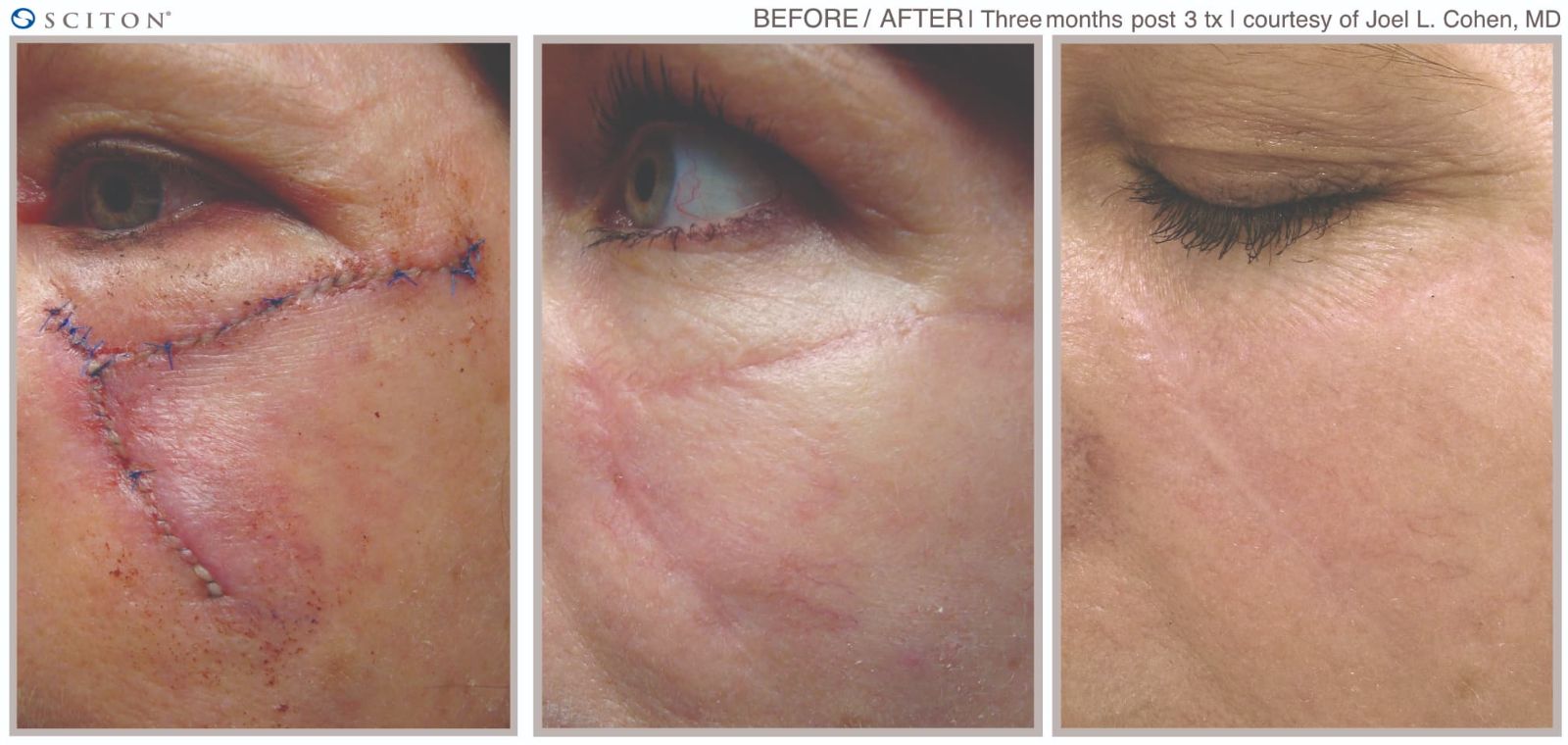 Before and After Laser Scar Treatment Case 4