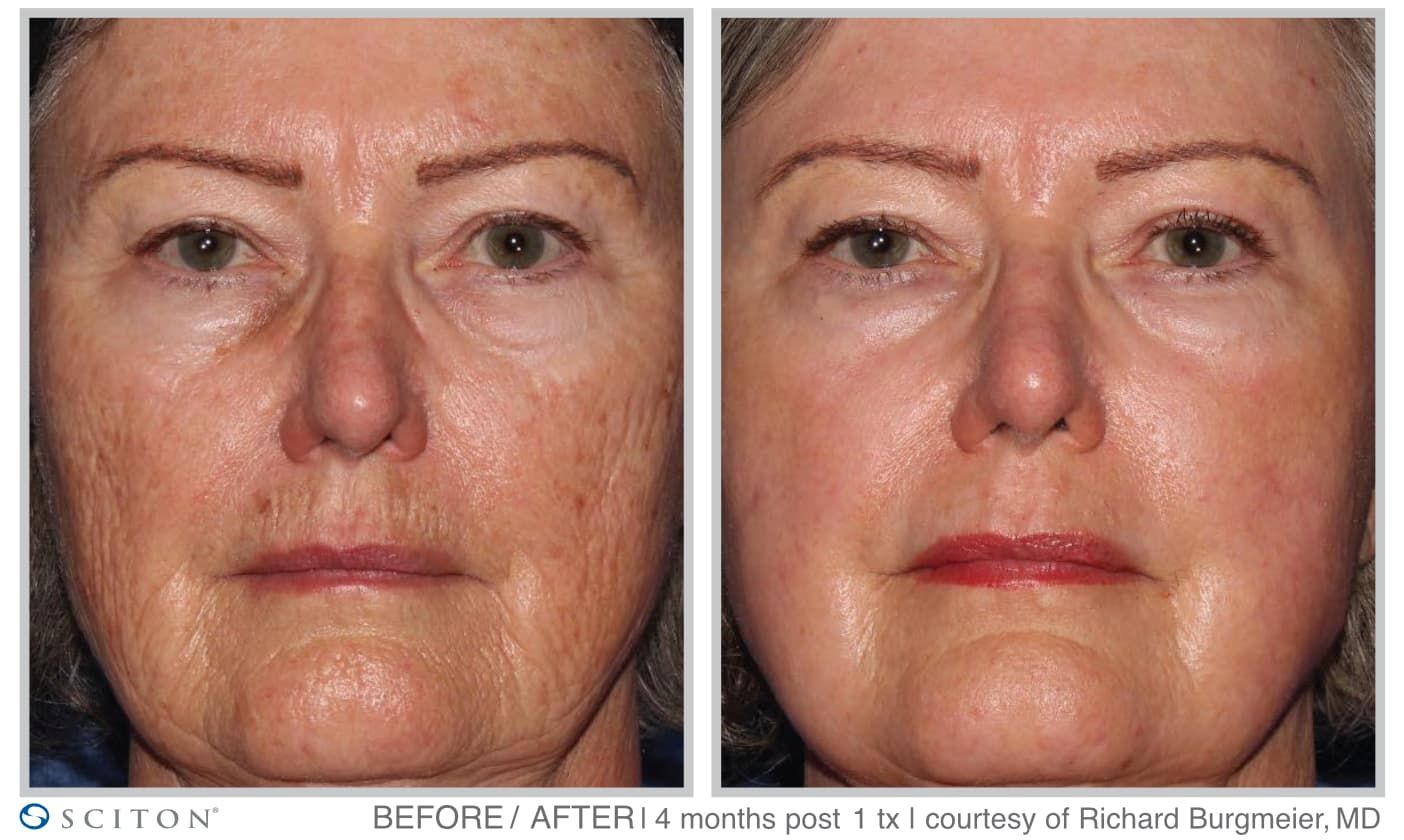 Before and After Deep Laser Resurfacing Treatment Case 5