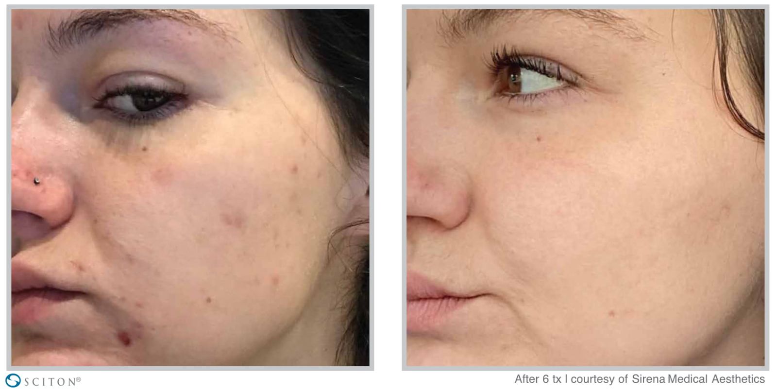 Before and After BBL Forever Clear Treatment Case 1