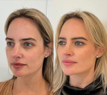 Skin Rejuvenation Results