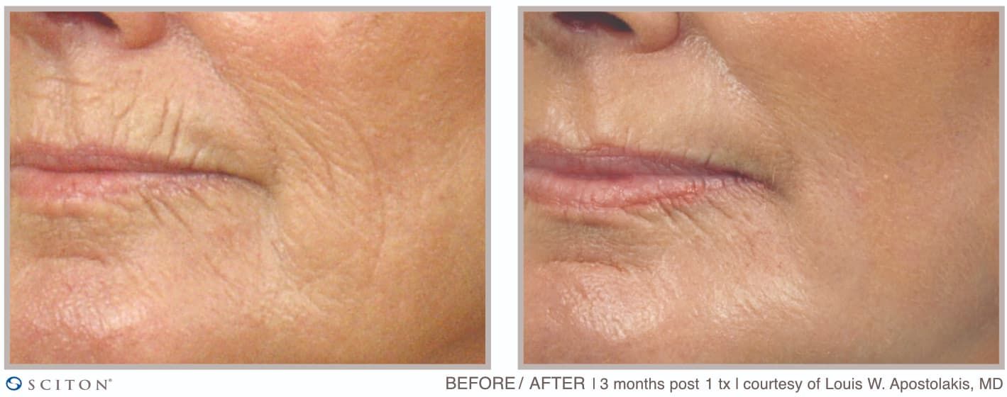 Before and After Deep Laser Resurfacing Treatment Case 4