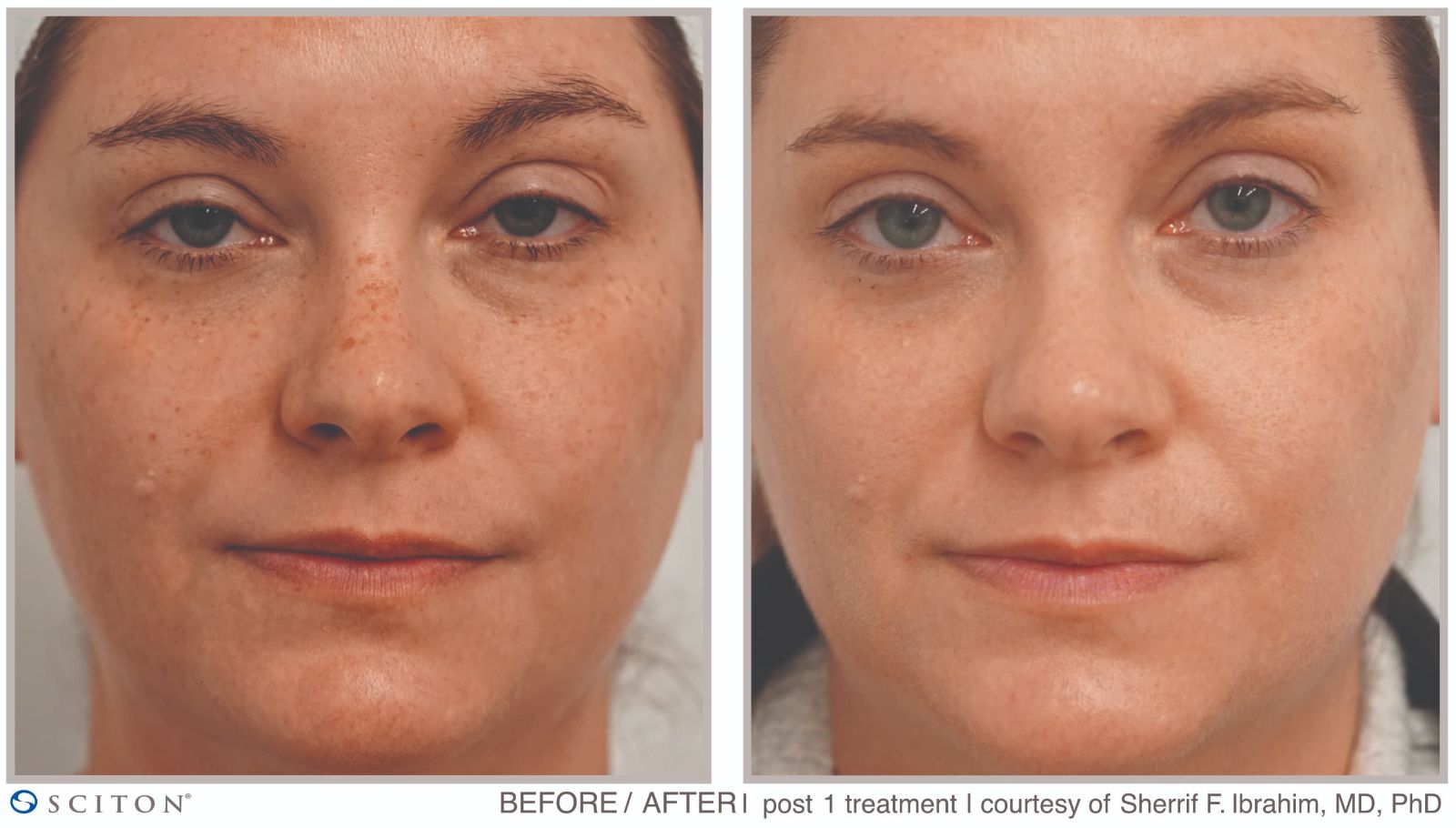 BBL HEROic Patient Results Case 2