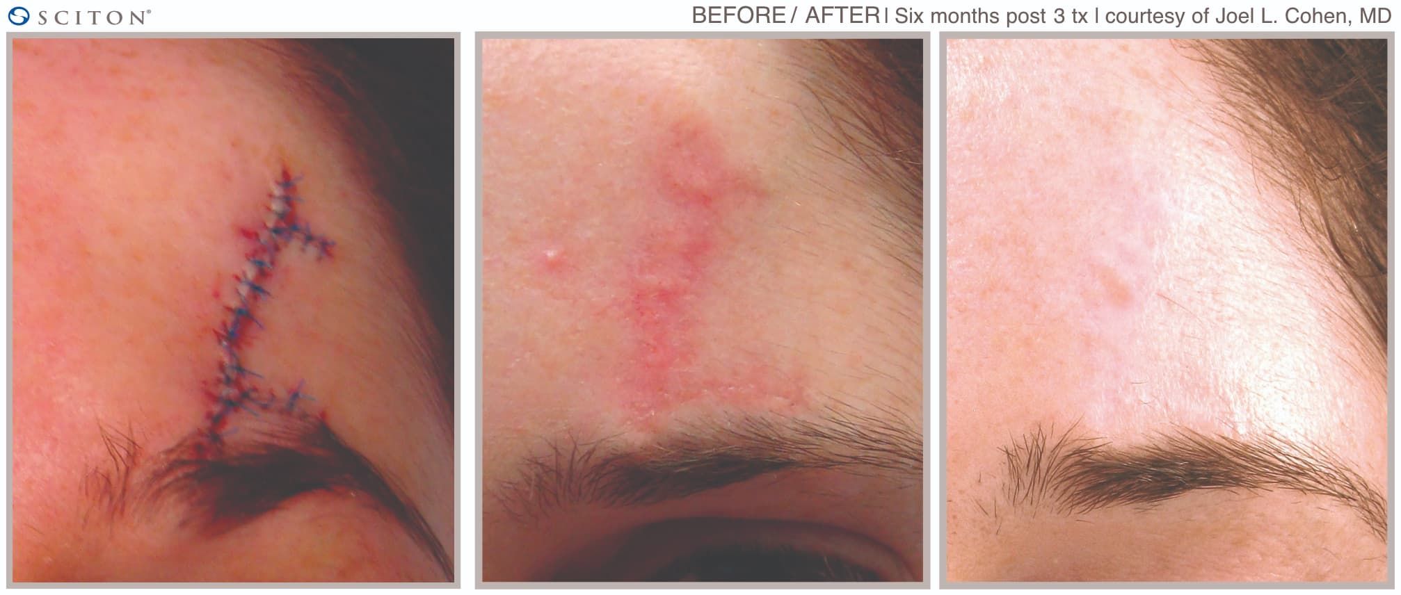 Before and After Laser Scar Treatment Case 5