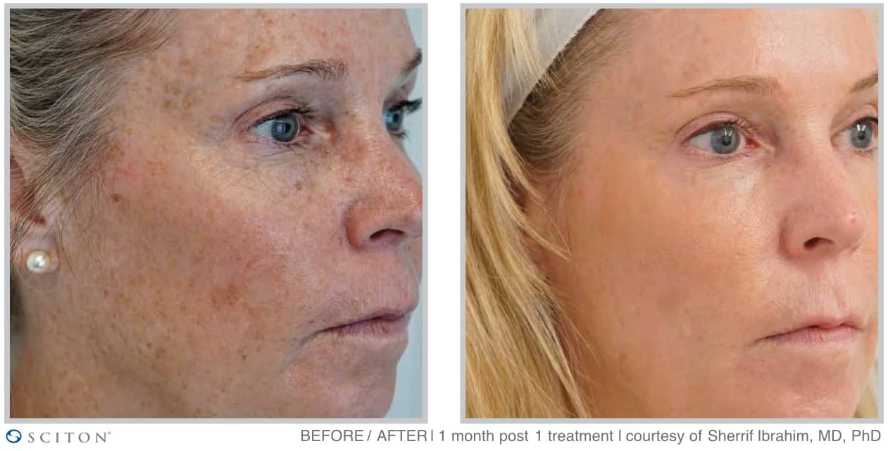 Before and After MOXI Treatment Case 1